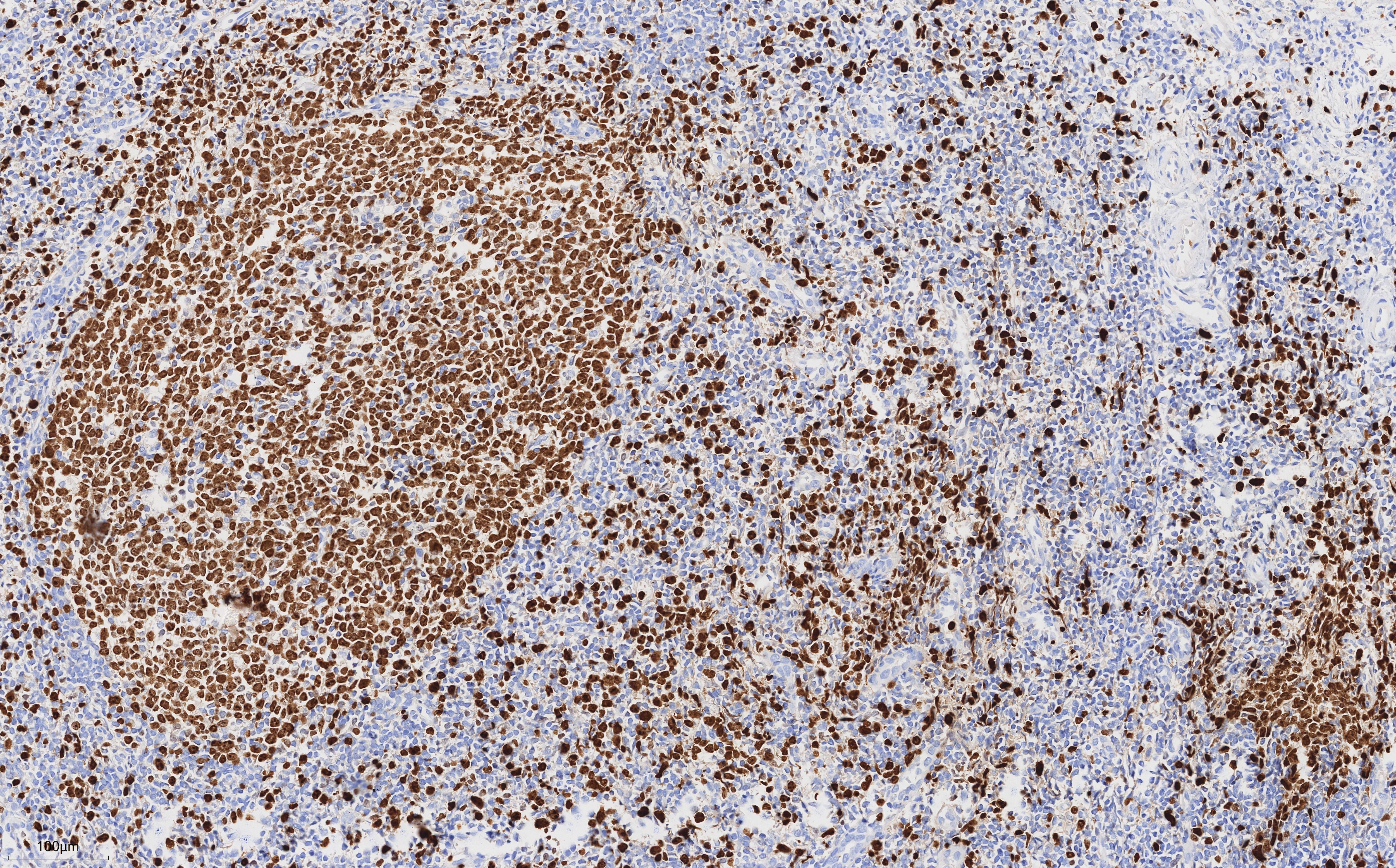 Immunohistochemistry of 84192-4-RR (Ki67 rabbit recombinant antibody, 1:10000) in human tonsillitis tissue. PR30018 (DAB) was used as substrate.