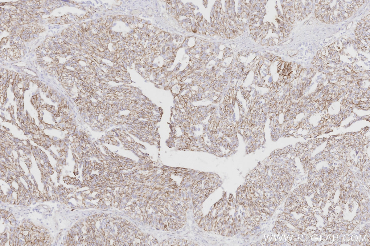 Immunohistochemical analysis of paraffin-embedded human ovary cancer tissue slide using 66379-1-Ig (Beta Catenin antibody) at dilution of 1:5000. Multi-rAb® Biotin-Goat Anti-Mouse Recombinant Secondary Antibody (H+L) was used at 6.5 ug/mL for signal amplification. HRP conjugated streptavidin was used for detection. Immunohistochemical analysis of paraffin-embedded human ovary cancer tissue slide using 66379-1-Ig (Beta Catenin antibody) at dilution of 1:5000. Multi-rAb® Biotin-Goat Anti-Mouse Recombinant Secondary Antibody (H+L) was used at 6.5 ug/mL for signal amplification. HRP conjugated streptavidin was used for detection.