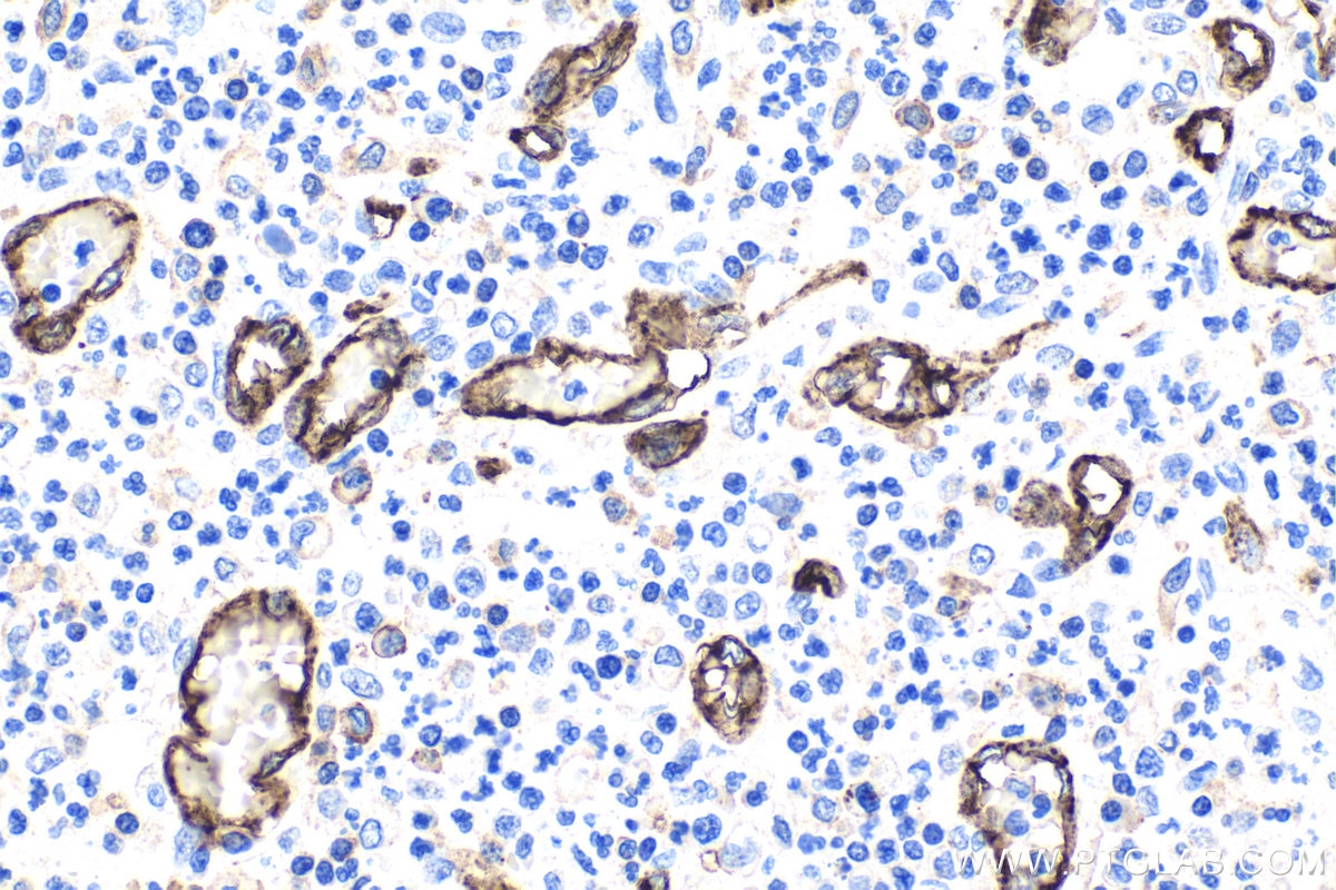 Immunohistochemical analysis of paraffin-embedded human colon cancer tissue slide using 66065-2-Ig (CD31 mouse monoclonal antibody) at dilution of 1:10000 . Heat mediated antigen retrieval with Tris-EDTA buffer (pH 9.0). Multi-rAb Polymer HRP-Goat anti-mouse Recombinant secondary antibody RGAM011 was used for detection.