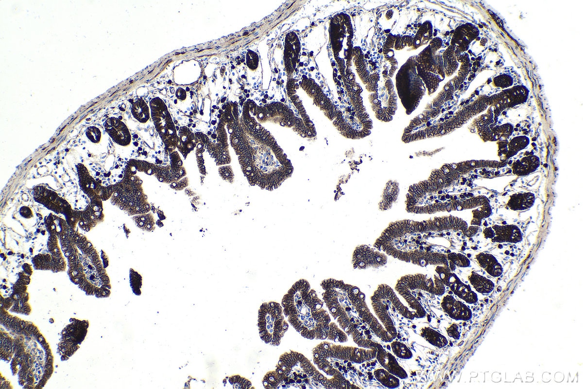 Immunohistochemical analysis of paraffin-embedded human colon cancer tissue slide using 66379-1-Ig (Beta Catenin mouse monoclonal antibody) at dilution of 1:20000 . Heat mediated antigen retrieval with Tris-EDTA buffer (pH 9.0). Multi-rAb Polymer HRP-Goat anti-mouse Recombinant secondary antibody RGAM011 was used for detection.