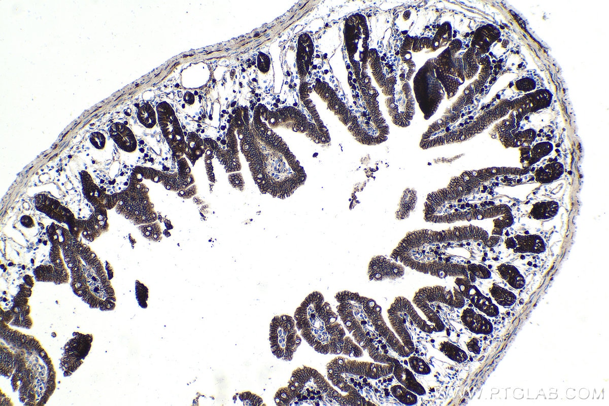 Immunohistochemical analysis of paraffin-embedded human colon cancer tissue slide using 66379-1-Ig (Beta Catenin mouse monoclonal antibody) at dilution of 1:20000 . Heat mediated antigen retrieval with Tris-EDTA buffer (pH 9.0). Multi-rAb™ Polymer HRP-Goat anti-mouse Recombinant secondary antibody RGAM011 was used for detection.