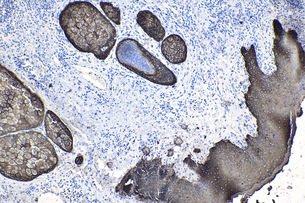 Immunohistochemical analysis of paraffin-embedded human skin cancer tissue slide using commercial IVD grade pan-CK mouse monoclonal antibody. Heat mediated antigen retrieval with Tris-EDTA buffer (pH 9.0). Multi-rAb Polymer HRP-Goat anti-mouse Recombinant secondary antibody RGAM011 was used for detection.
