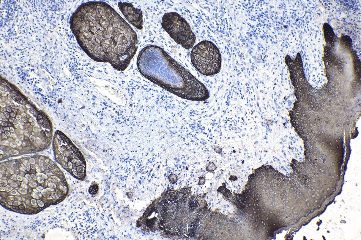 Immunohistochemical analysis of paraffin-embedded human skin cancer tissue slide using commercial IVD grade pan-CK mouse monoclonal antibody. Heat mediated antigen retrieval with Tris-EDTA buffer (pH 9.0). Multi-rAb™ Polymer HRP-Goat anti-mouse Recombinant secondary antibody RGAM011 was used for detection.