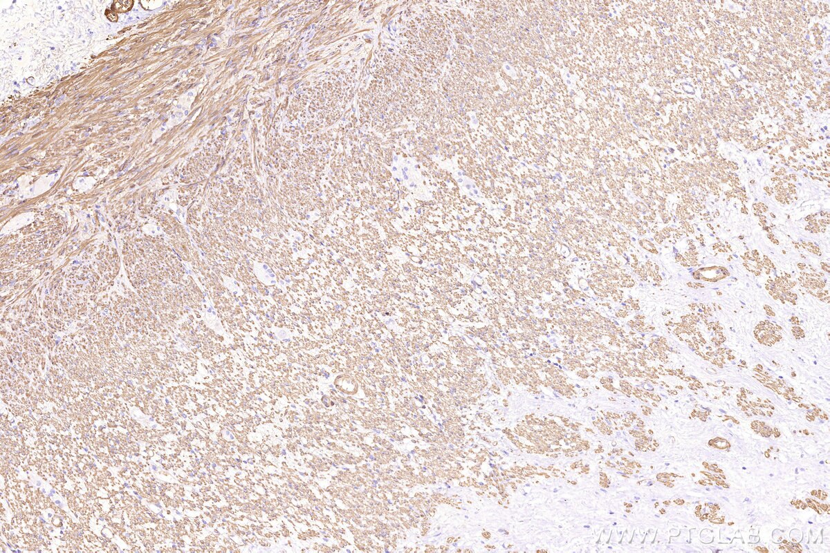 Immunohistochemical analysis of paraffin-embedded human appendicitis tissue slide using 80008-1-RR (Alpha smooth muscle actin specific antibody) at dilution of 1:10000. Multi-rAb® Biotin-Goat Anti-Rabbit Recombinant Secondary Antibody (H+L) was used at 4 ug/mL for signal amplification. HRP conjugated streptavidin was used for detection. Immunohistochemical analysis of paraffin-embedded human appendicitis tissue slide using 80008-1-RR (Alpha smooth muscle actin specific antibody) at dilution of 1:10000. Multi-rAb® Biotin-Goat Anti-Rabbit Recombinant Secondary Antibody (H+L) was used at 4 ug/mL for signal amplification. HRP conjugated streptavidin was used for detection.