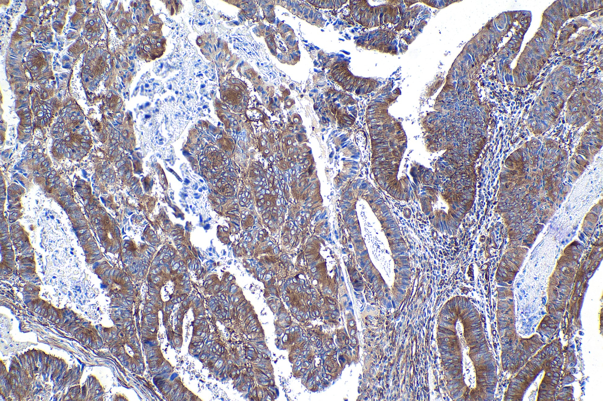 Immunohistochemical analysis of paraffin-embedded human colon cancer tissue slide using other vendor's NF-kappa B p65 rabbit recombinant antibody. Heat mediated antigen retrieval with Tris-EDTA buffer (pH 9.0). Multi-rAb™ Polymer HRP-Goat anti-rabbit Recombinant secondary antibody RGAR011 was used for detection.
