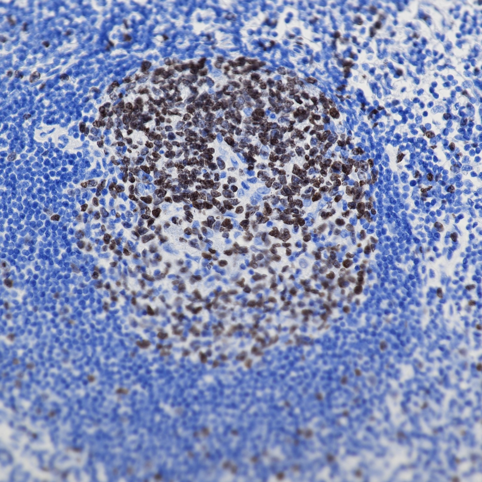 Immunohistochemical analysis of paraffin-embedded human tonsillitis tissue slide using commercial IVD grade KI67 antibody. Heat mediated antigen retrieval with Tris-EDTA buffer (pH 9.0). Multi-rAb Polymer HRP-Goat anti-rabbit Recombinant secondary antibody RGAR011 was used for detection.