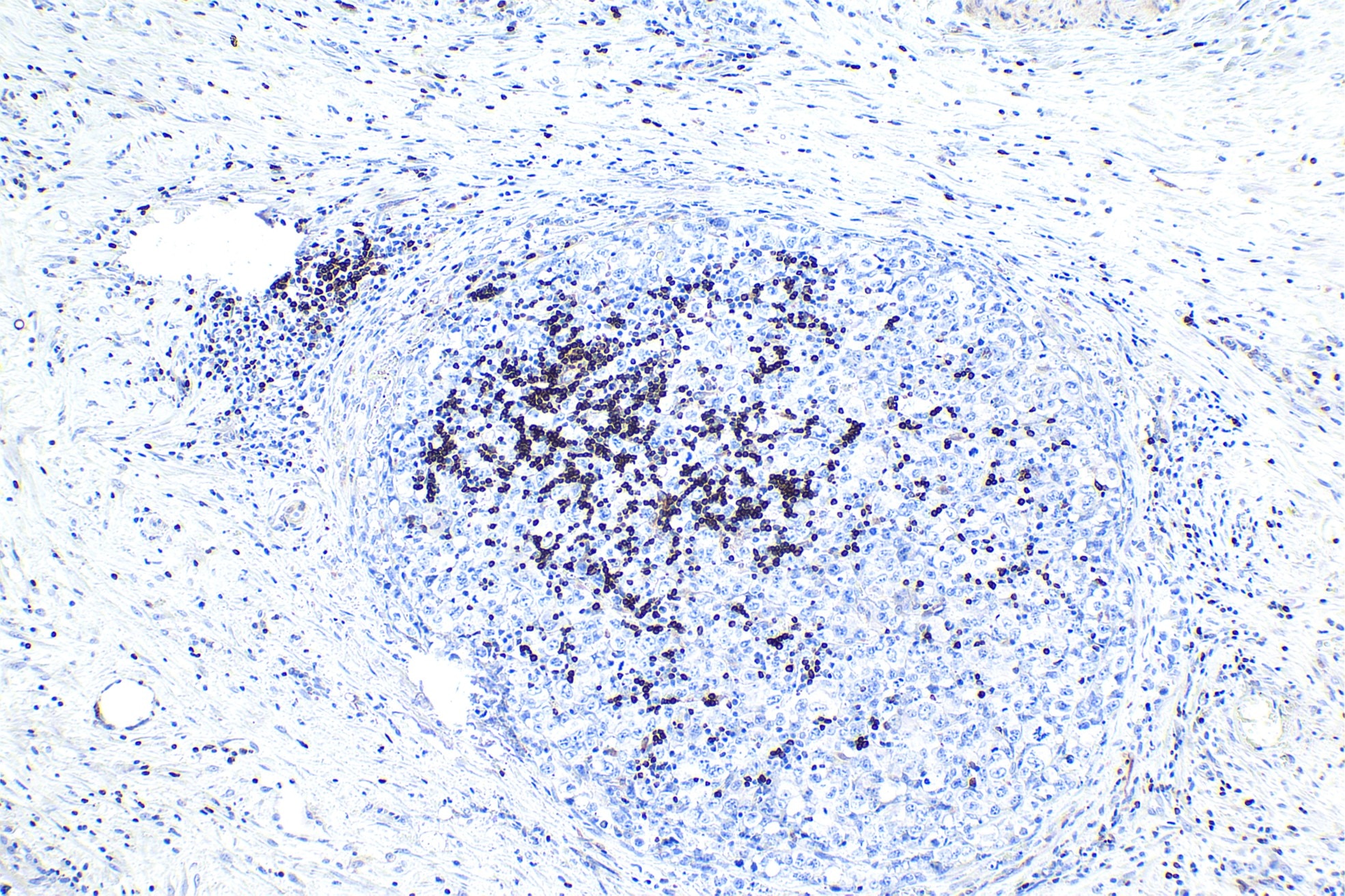 Immunohistochemical analysis of paraffin-embedded human lymphoma tissue slide using other vendor's BCL2 rabbit recombinant antibody. Heat mediated antigen retrieval with Tris-EDTA buffer (pH 9.0). Multi-rAb Polymer HRP-Goat anti-rabbit Recombinant secondary antibody RGAR011 was used for detection.