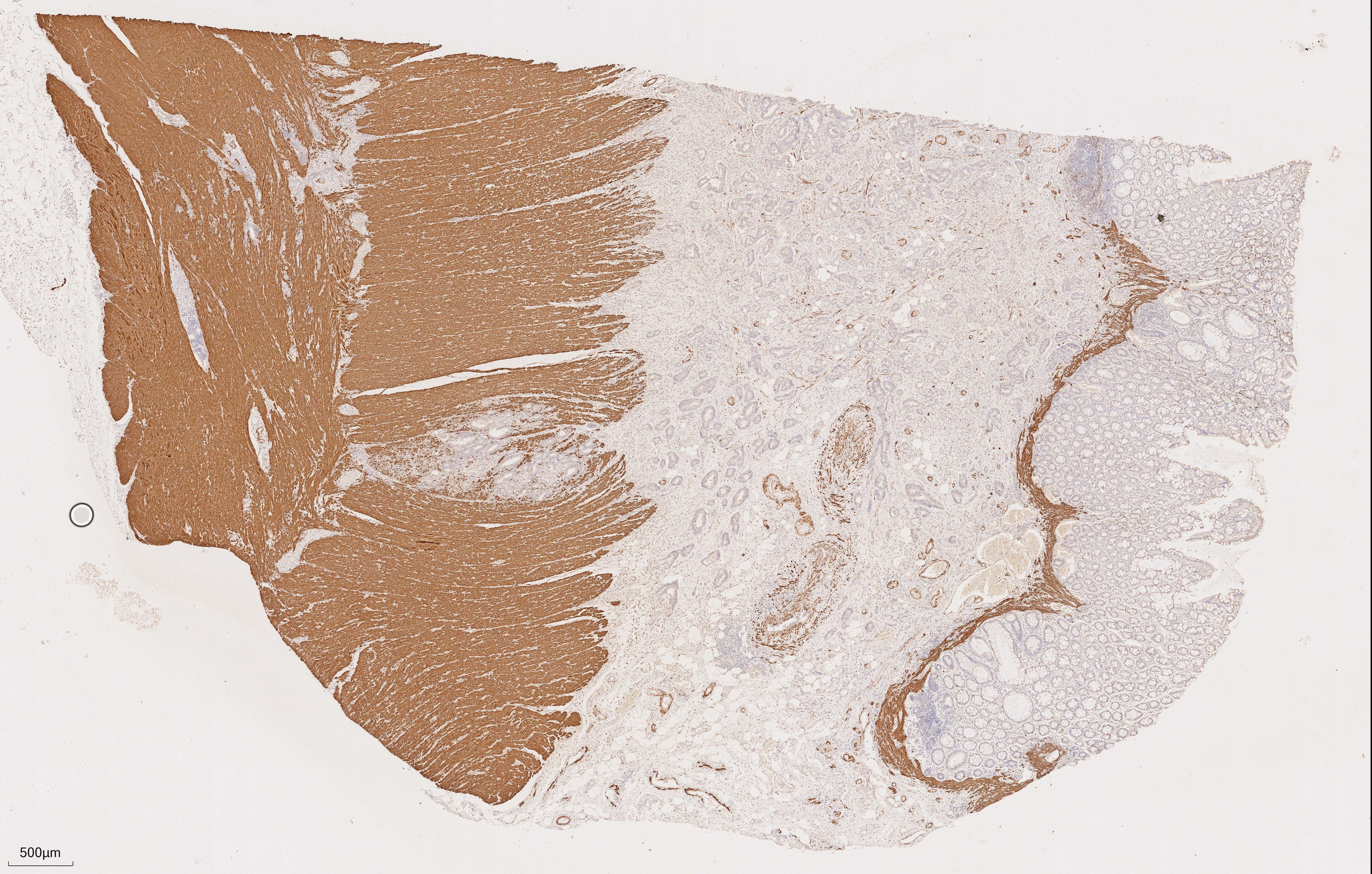 Immunohistochemical analysis of paraffin-embedded human rectal cancer tissue slide using 67793-1-Ig (Desmin mouse monoclonal antibody) at dilution of 1:2000. Heat mediated antigen retrieval with Tris-EDTA buffer (pH 9.0). Multi-rAb™ Enhanced Anti-Rabbit/Mouse Universal Secondary System Plus  RGAU015 was used for detection.
