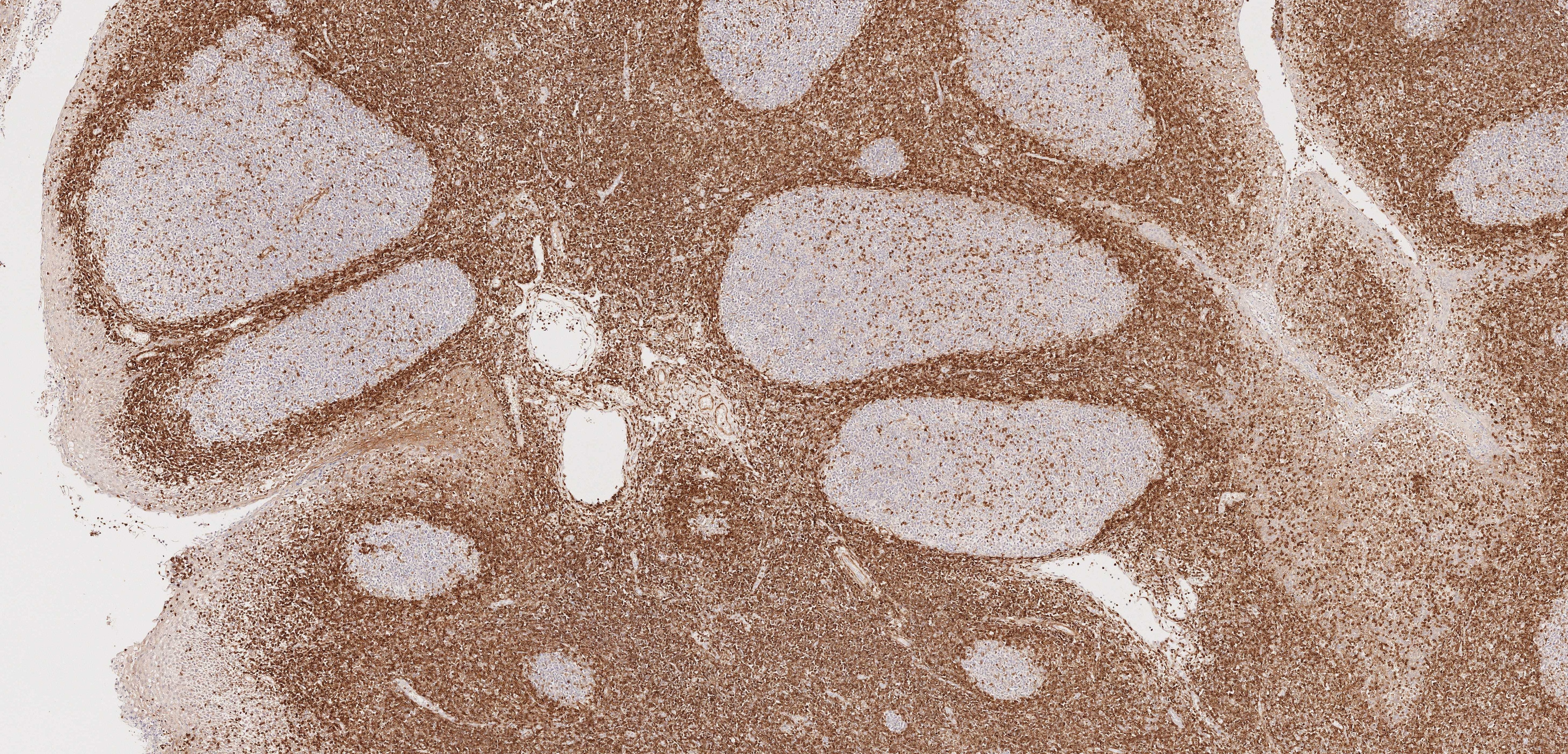 Immunohistochemical analysis of paraffin-embedded human tonsillitis tissue slide using 60178-1-Ig (BCL2 antibody) at dilution of 1:10000. Heat mediated antigen retrieval with Tris-EDTA buffer (pH 9.0). Multi-rAb™ Enhanced Anti-Rabbit/Mouse Universal Secondary System Plus RGAU015 was used for detection.