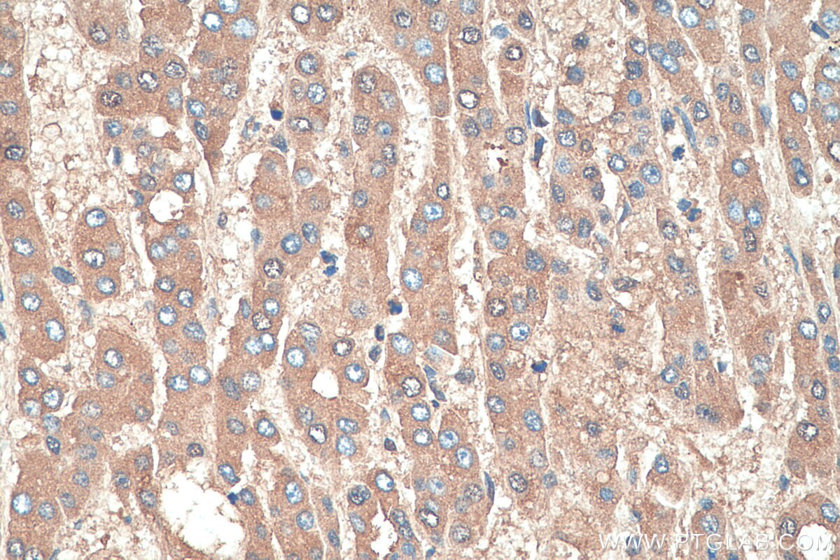 Immunohistochemical analysis of paraffin-embedded human liver cancer tissue slide using KHC0379 (SERPINA1/AAT IHC Kit).