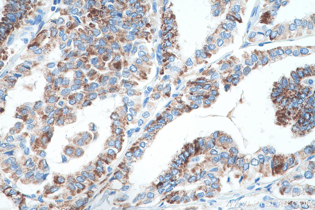 Immunohistochemical analysis of paraffin-embedded human thyroid cancer tissue slide using KHC0547 (ABAT IHC Kit).