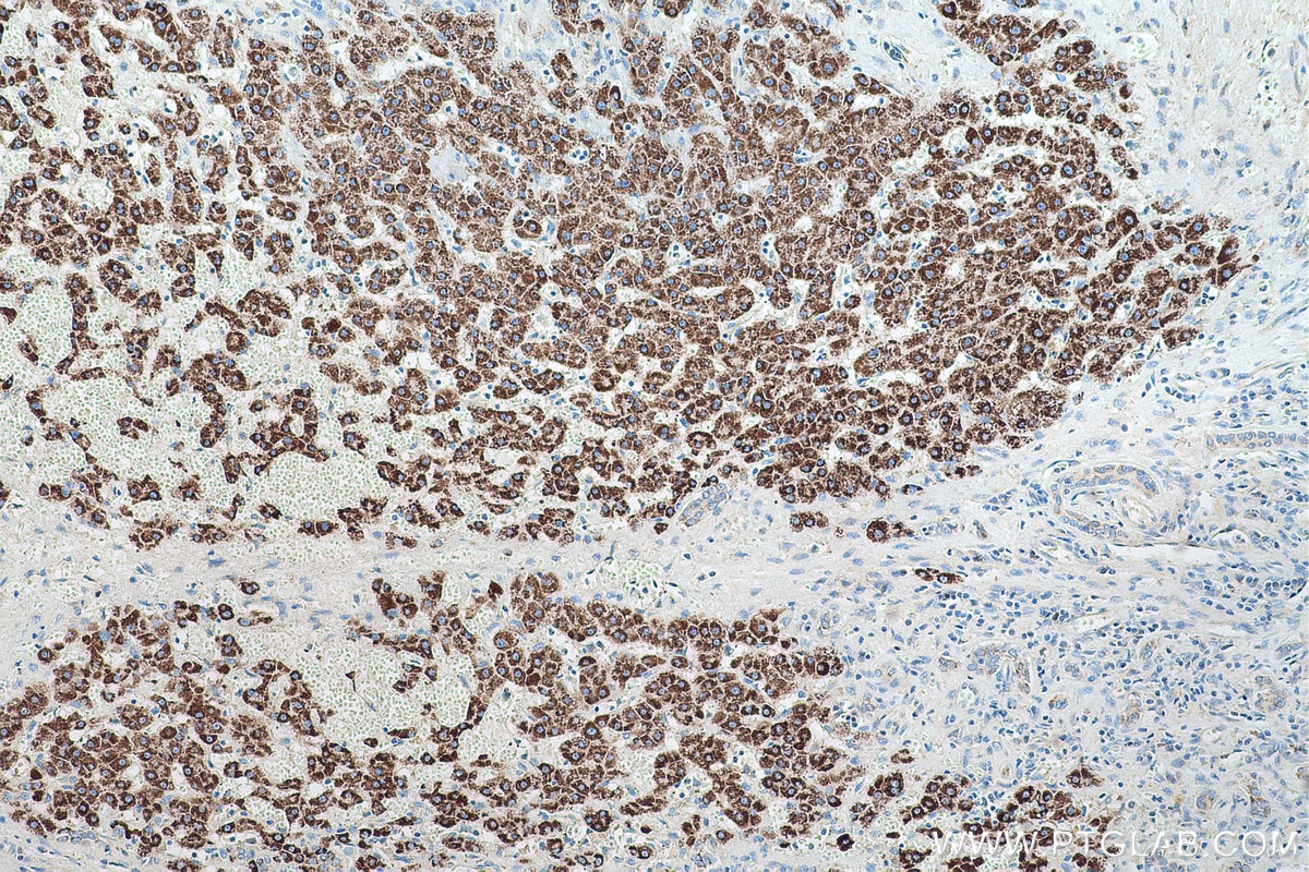 Immunohistochemical analysis of paraffin-embedded human liver cancer tissue slide using KHC0547 (ABAT IHC Kit).
