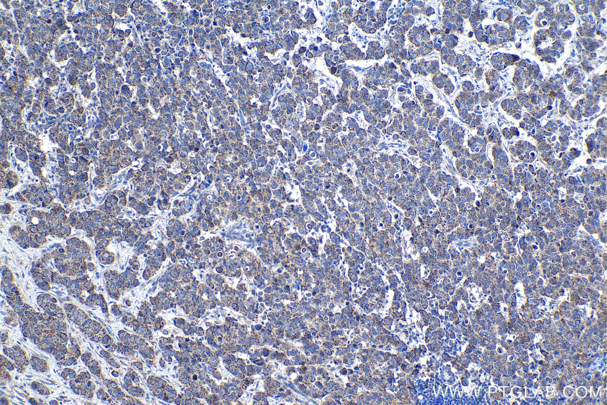 Immunohistochemical analysis of paraffin-embedded human breast cancer tissue slide using KHC1348 (ABCB9 IHC Kit).