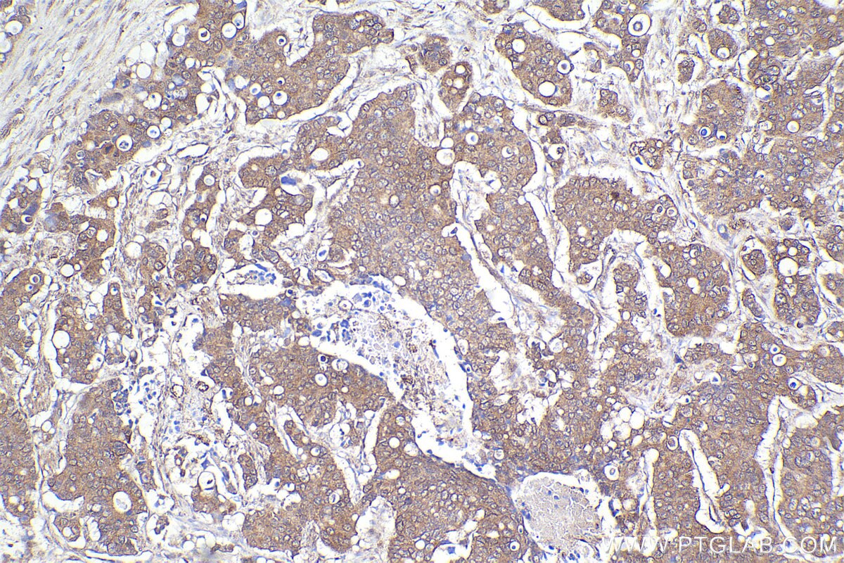 Immunohistochemical analysis of paraffin-embedded human stomach cancer tissue slide using KHC2216 (ABCD3 IHC Kit).