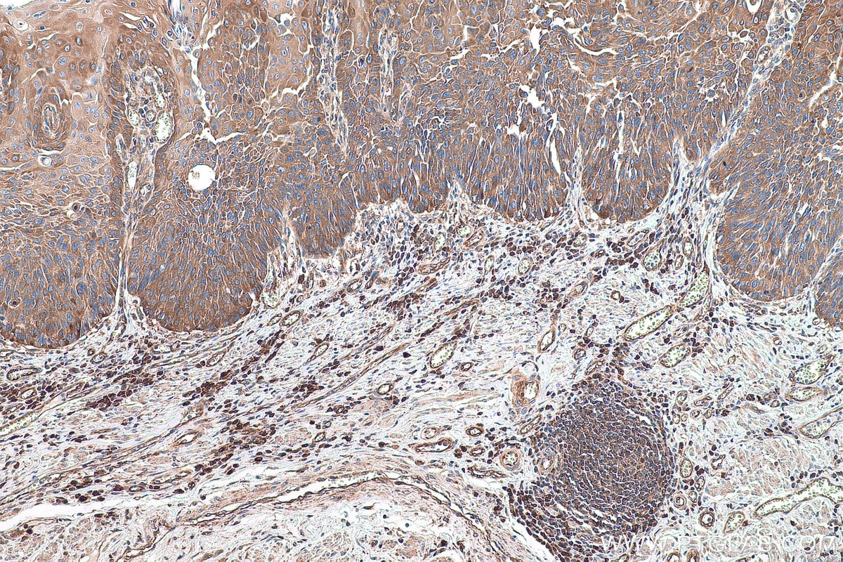 Immunohistochemical analysis of paraffin-embedded human oesophagus cancer tissue slide using KHC0909 (ABCE1 IHC Kit).