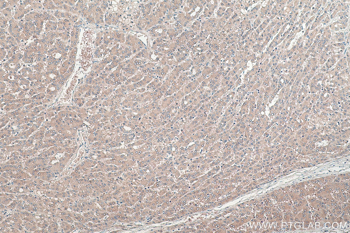 Immunohistochemical analysis of paraffin-embedded human liver cancer tissue slide using KHC0392 (ABHD14B IHC Kit).