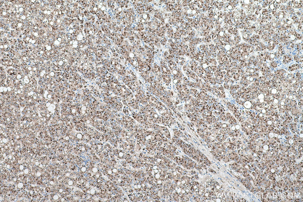 Immunohistochemical analysis of paraffin-embedded human liver cancer tissue slide using KHC0555 (ACAA1 IHC Kit).