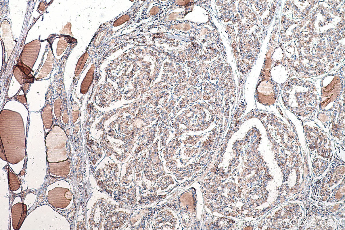 Immunohistochemical analysis of paraffin-embedded human thyroid cancer tissue slide using KHC0555 (ACAA1 IHC Kit).