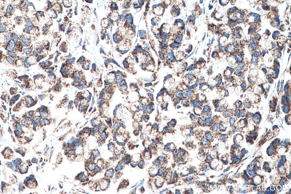 Immunohistochemical analysis of paraffin-embedded human colon cancer tissue slide using KHC0502 (ACAA2 IHC Kit).