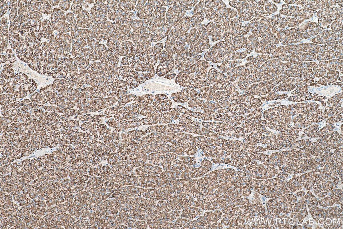 Immunohistochemical analysis of paraffin-embedded human liver cancer tissue slide using KHC0502 (ACAA2 IHC Kit).