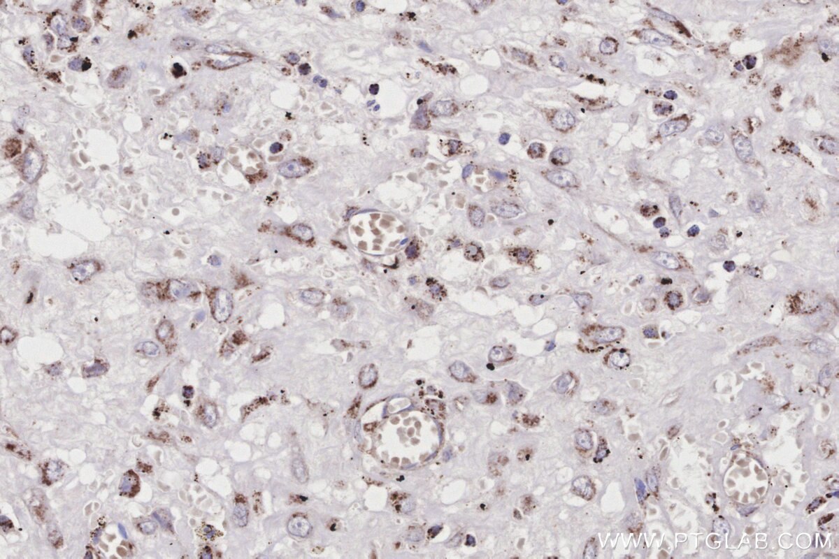 Immunohistochemical analysis of paraffin-embedded human colon cancer tissue slide using KHC3189 (ACADS IHC Kit). Immunohistochemical analysis of paraffin-embedded human colon cancer tissue slide using KHC3189 (ACADS IHC Kit).