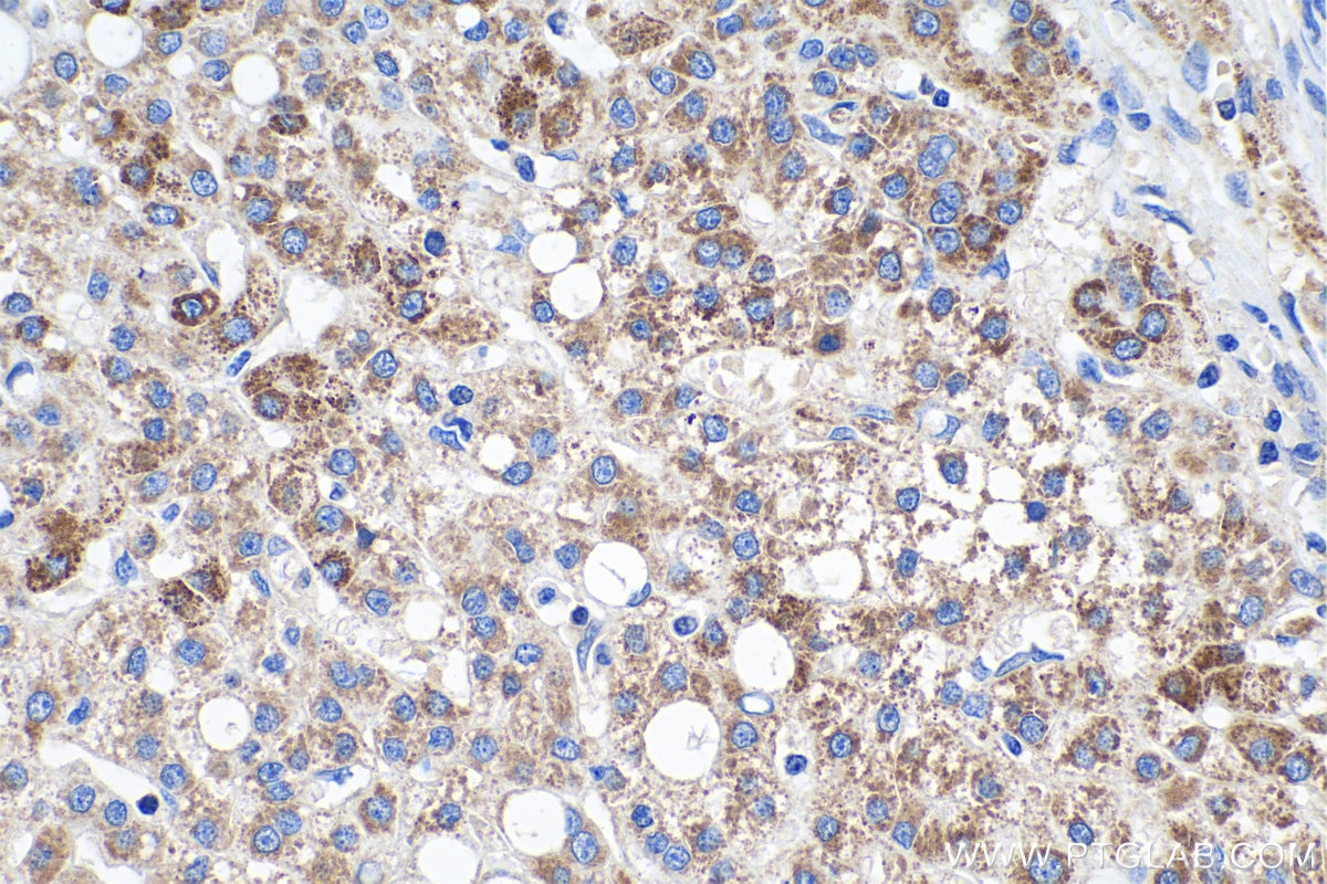 Immunohistochemical analysis of paraffin-embedded human liver cancer tissue slide using KHC0537 (ACADSB IHC Kit).