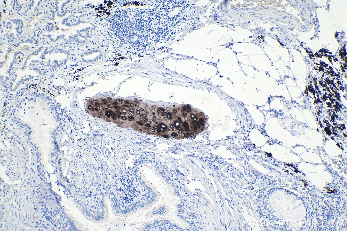 Immunohistochemical analysis of paraffin-embedded human lung cancer tissue slide using KHC1052 (ACAN IHC Kit).