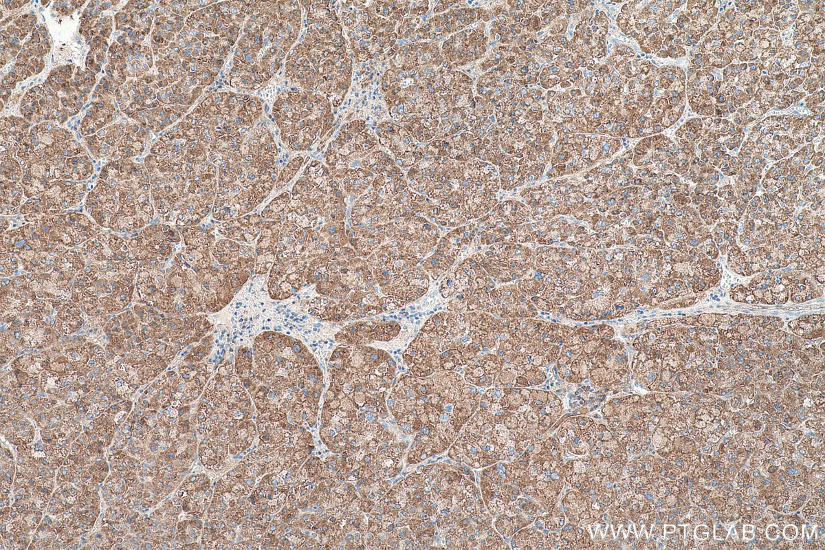 Immunohistochemical analysis of paraffin-embedded human liver cancer tissue slide using KHC0504 (ACAT1 IHC Kit).