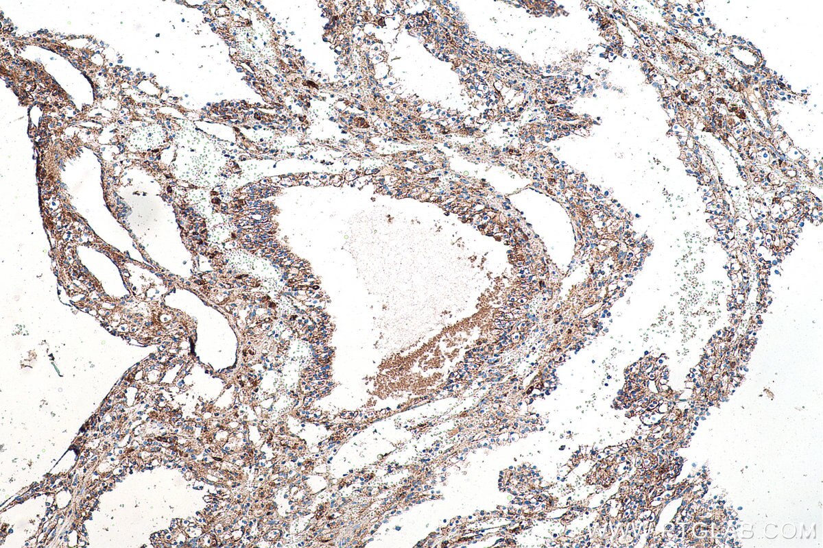 Immunohistochemical analysis of paraffin-embedded human renal cell carcinoma tissue slide using KHC0504 (ACAT1 IHC Kit).