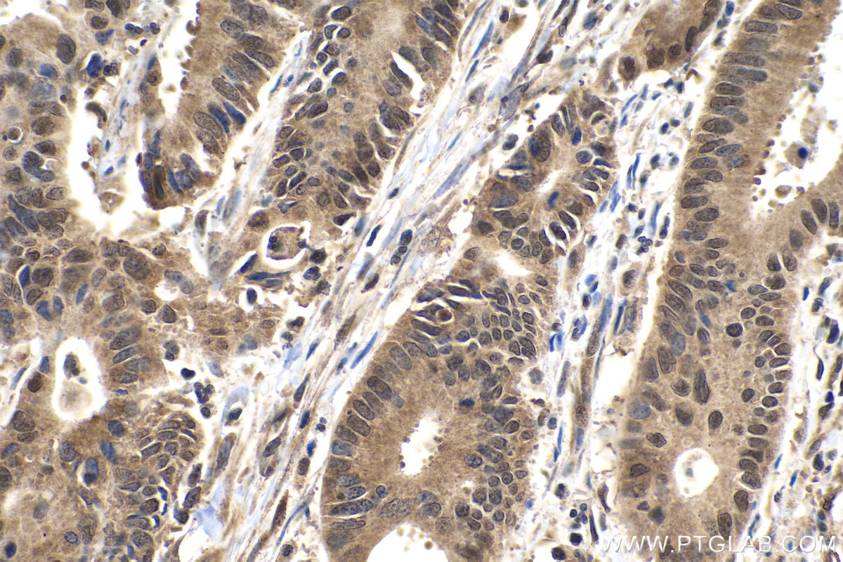 Immunohistochemical analysis of paraffin-embedded human colon cancer tissue slide using KHC0227 (ACLY IHC Kit).