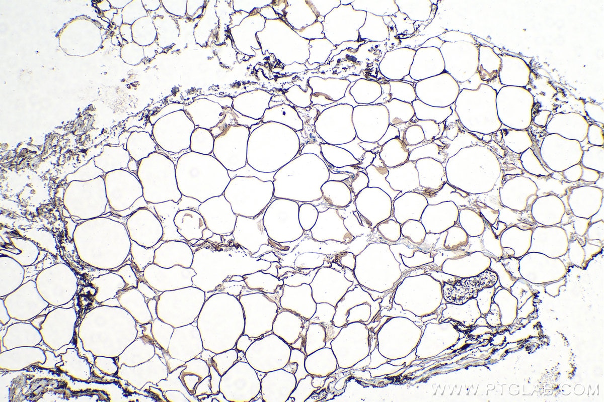 Immunohistochemical analysis of paraffin-embedded human prostate cancer tissue slide using KHC0227 (ACLY IHC Kit).