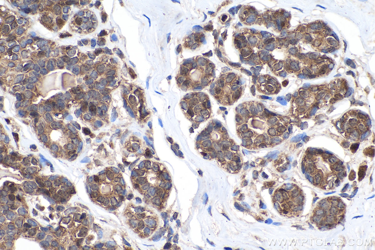 Immunohistochemical analysis of paraffin-embedded human breast cancer tissue slide using KHC0227 (ACLY IHC Kit).