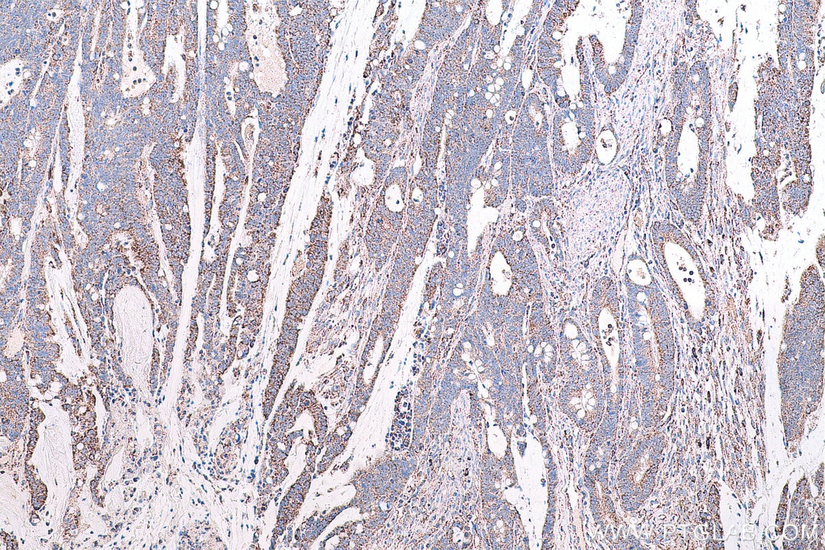 Immunohistochemical analysis of paraffin-embedded human colon cancer tissue slide using KHC0674 (ACO2 IHC Kit).