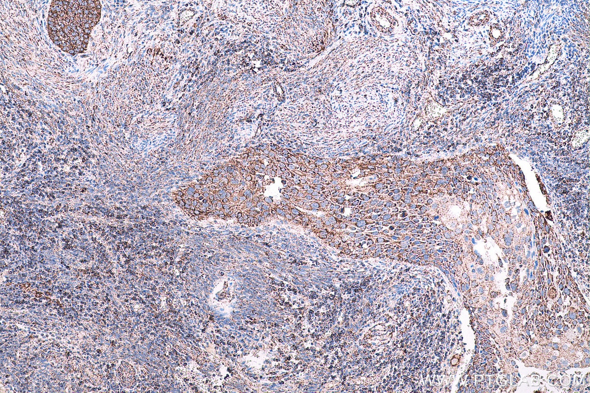 Immunohistochemical analysis of paraffin-embedded human cervical cancer tissue slide using KHC0674 (ACO2 IHC Kit).