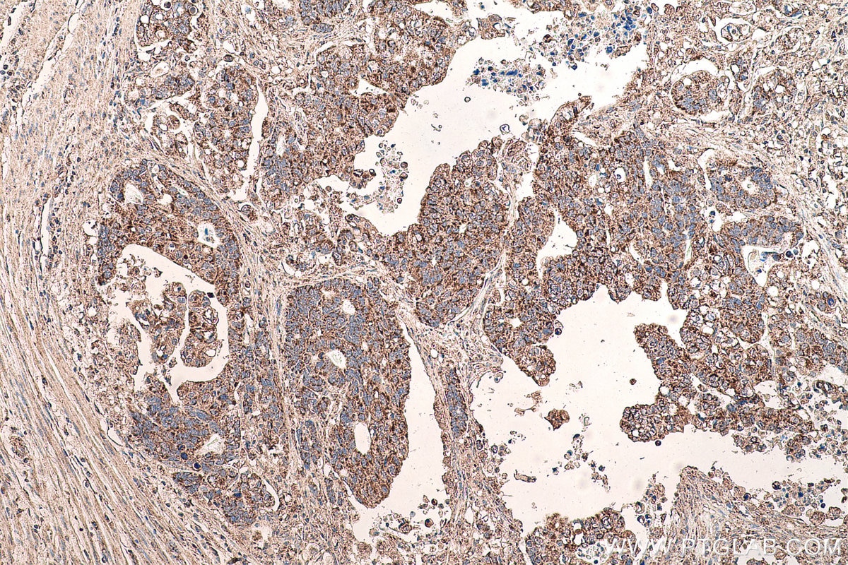 Immunohistochemical analysis of paraffin-embedded human stomach cancer tissue slide using KHC0674 (ACO2 IHC Kit).