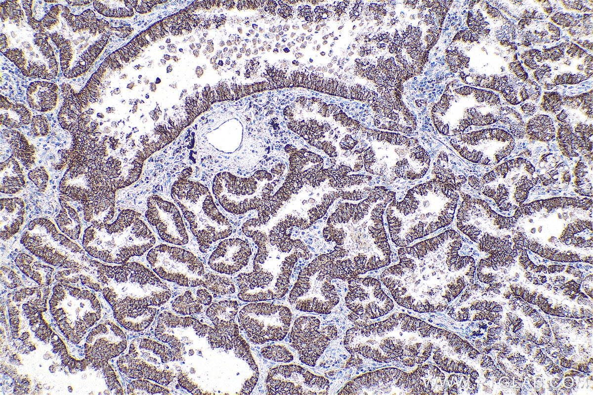 Immunohistochemical analysis of paraffin-embedded human lung cancer tissue slide using KHC0878 (ACOT13/THEM2 IHC Kit).