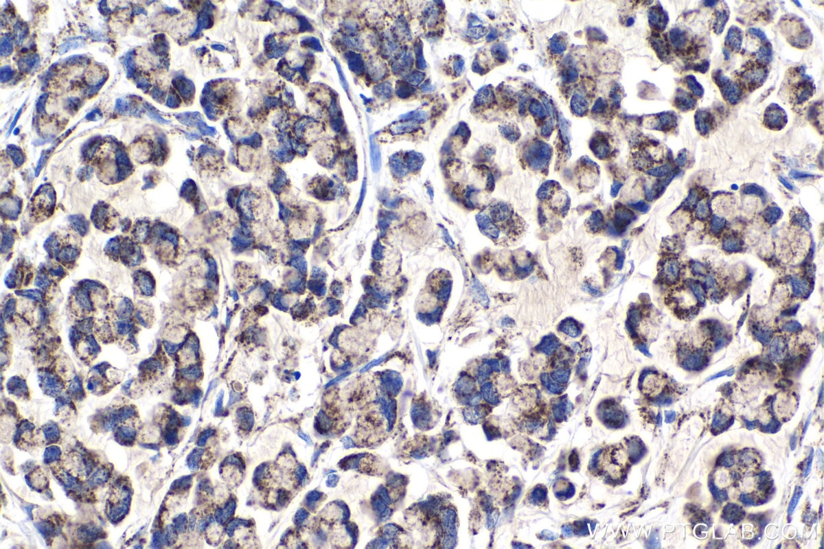 Immunohistochemical analysis of paraffin-embedded human colon cancer tissue slide using KHC1038 (ACOT9 IHC Kit).
