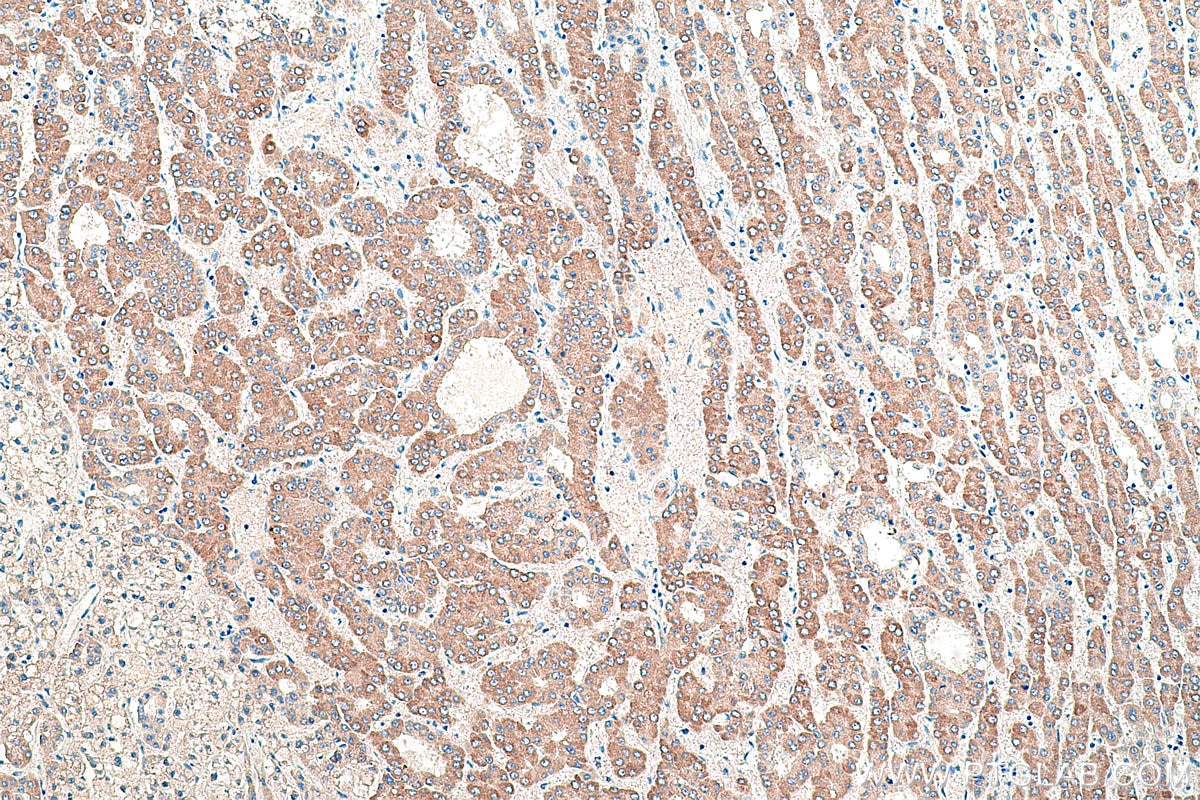 Immunohistochemical analysis of paraffin-embedded human liver cancer tissue slide using KHC0393 (ACSL1 IHC Kit).