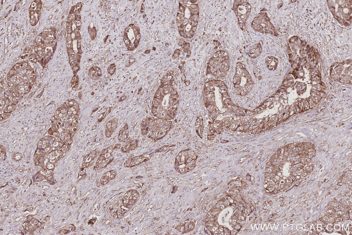 Immunohistochemical analysis of paraffin-embedded human pancreas cancer tissue slide using KHC3033 (ACSL5 IHC Kit).
