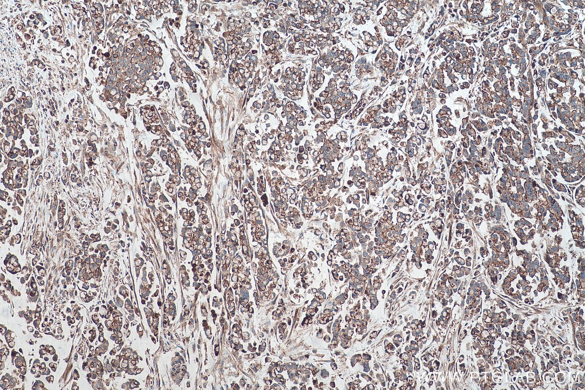 Immunohistochemical analysis of paraffin-embedded human colon cancer tissue slide using KHC0512 (ACTG1 IHC Kit).