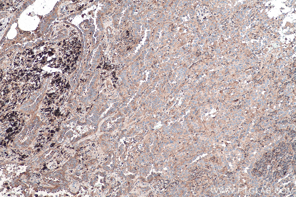 Immunohistochemical analysis of paraffin-embedded human lung cancer tissue slide using KHC0512 (ACTG1 IHC Kit).
