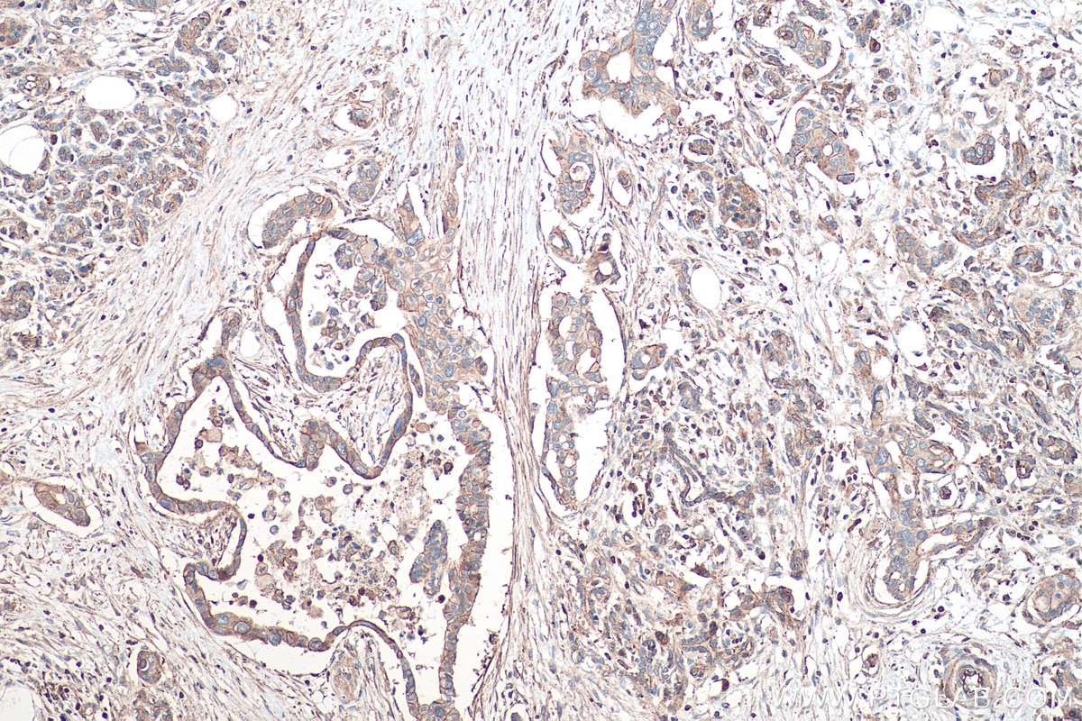 Immunohistochemical analysis of paraffin-embedded human pancreas cancer tissue slide using KHC0512 (ACTG1 IHC Kit).