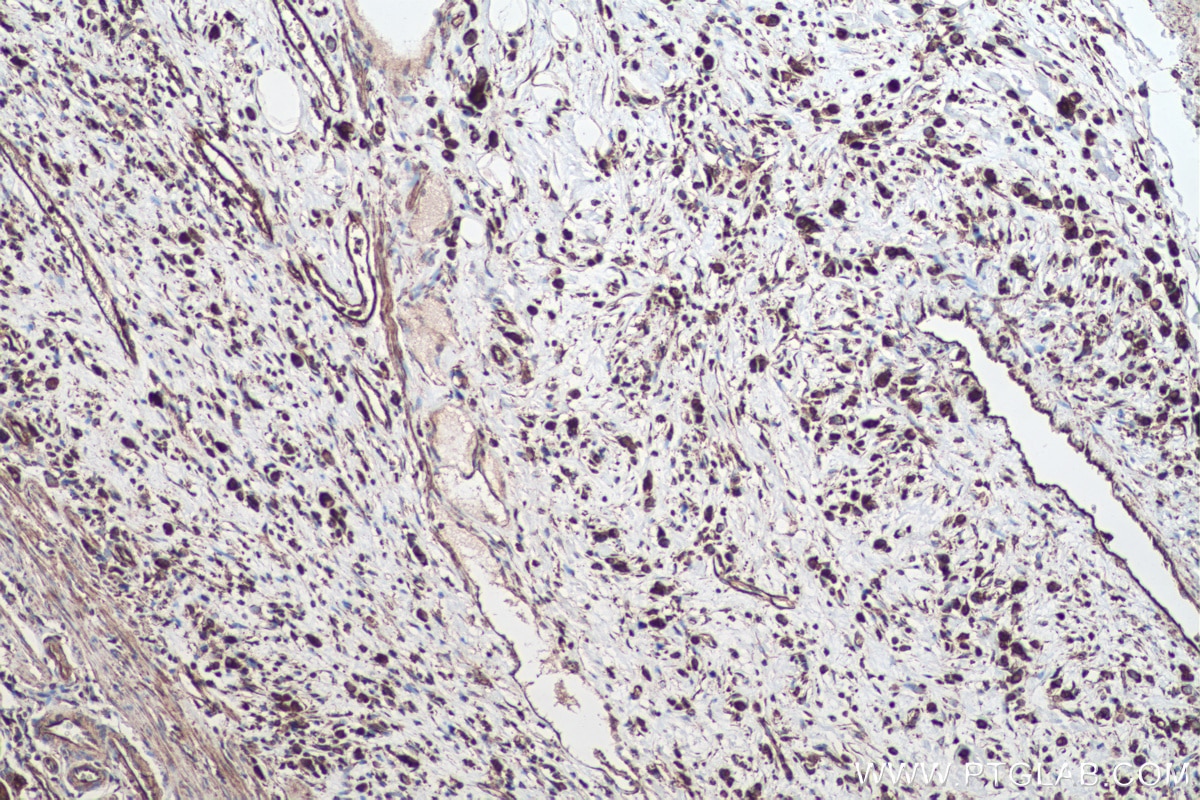 Immunohistochemical analysis of paraffin-embedded human stomach cancer tissue slide using KHC0512 (ACTG1 IHC Kit).