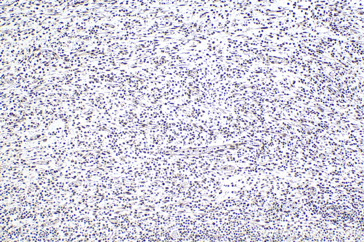 Immunohistochemical analysis of paraffin-embedded human colon cancer tissue slide using KHC0982 (ACTL6A IHC Kit).