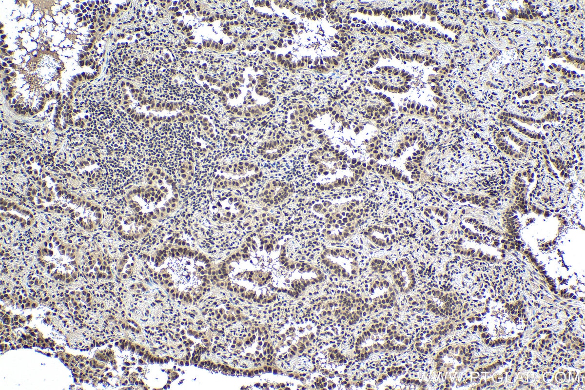 Immunohistochemical analysis of paraffin-embedded human lung cancer tissue slide using KHC0982 (ACTL6A IHC Kit).