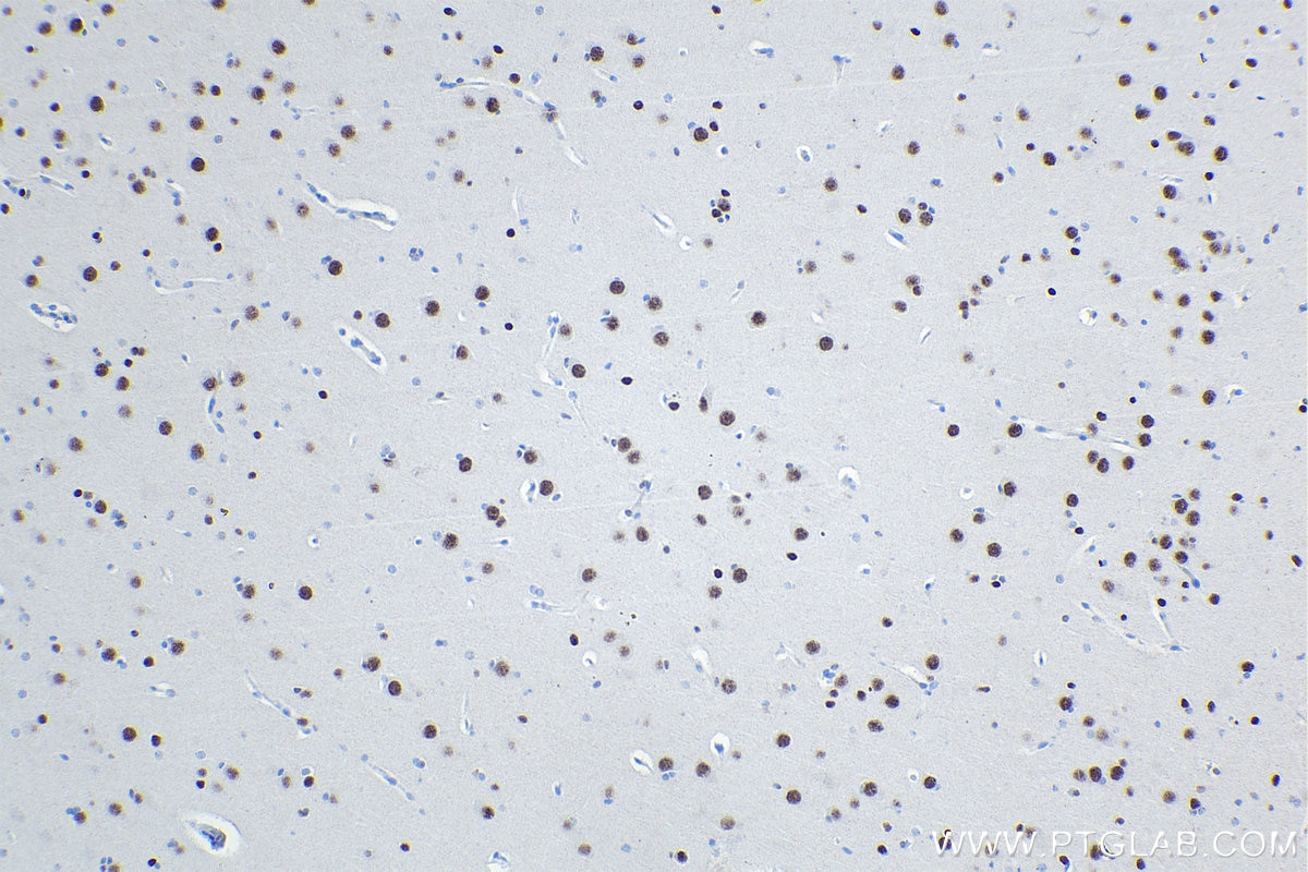 Immunohistochemical analysis of paraffin-embedded human gliomas tissue slide using KHC1482 (ACTL6B IHC Kit).