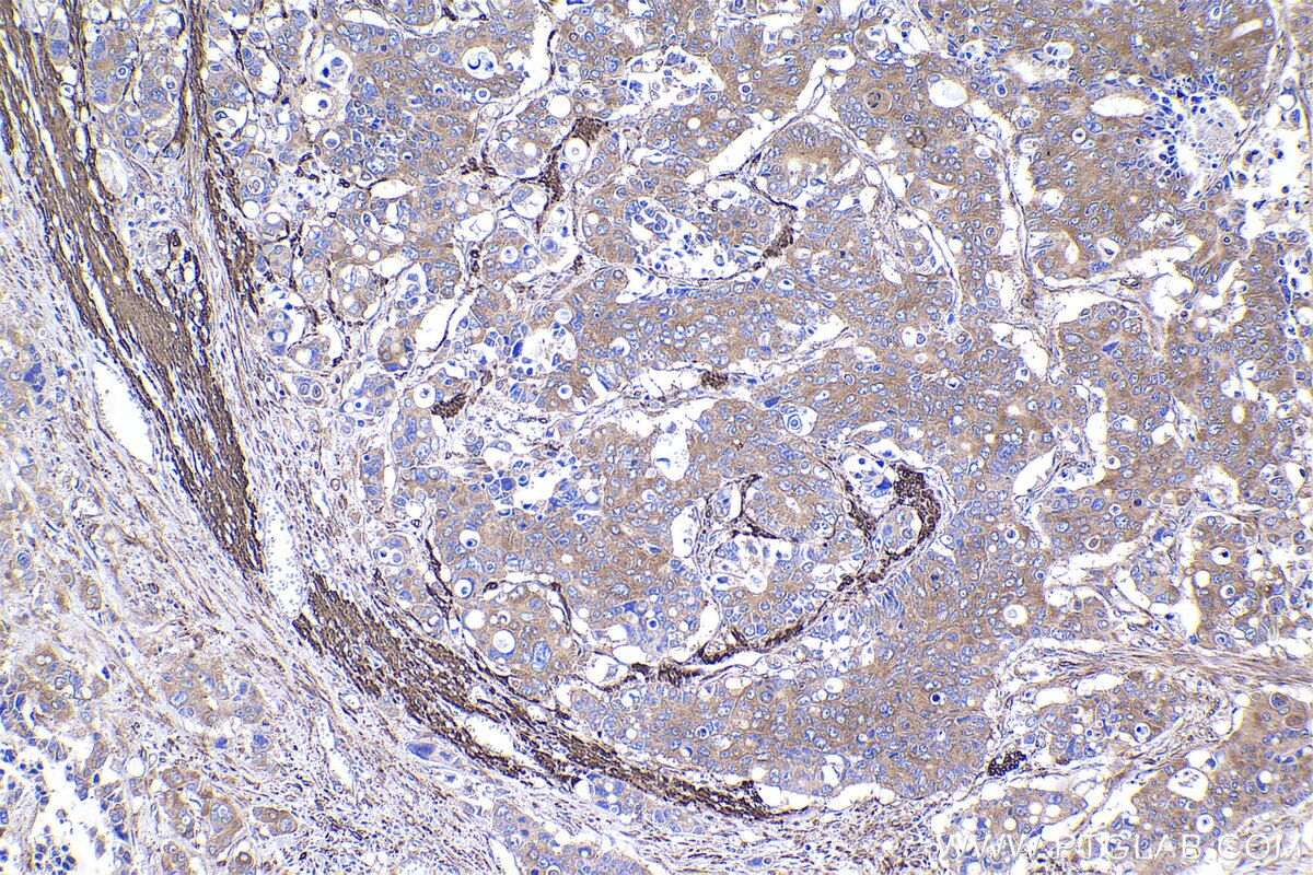 Immunohistochemical analysis of paraffin-embedded human stomach cancer tissue slide using KHC2338 (ACTR1A IHC Kit).