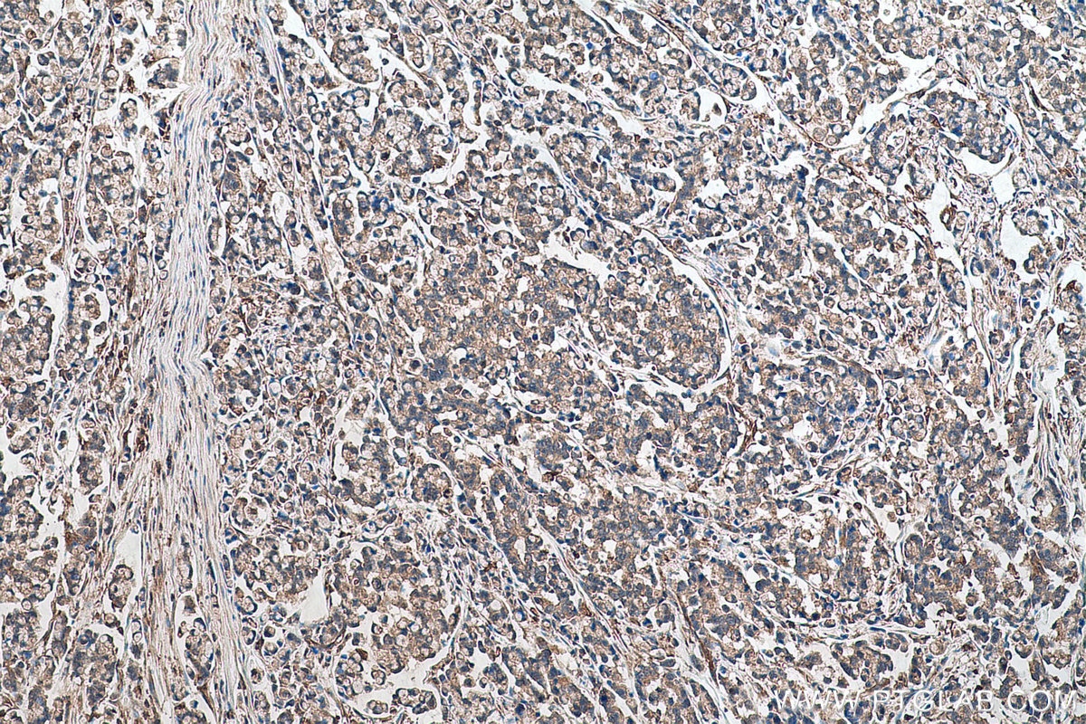 Immunohistochemical analysis of paraffin-embedded human colon cancer tissue slide using KHC0728 (ACTR2 IHC Kit).