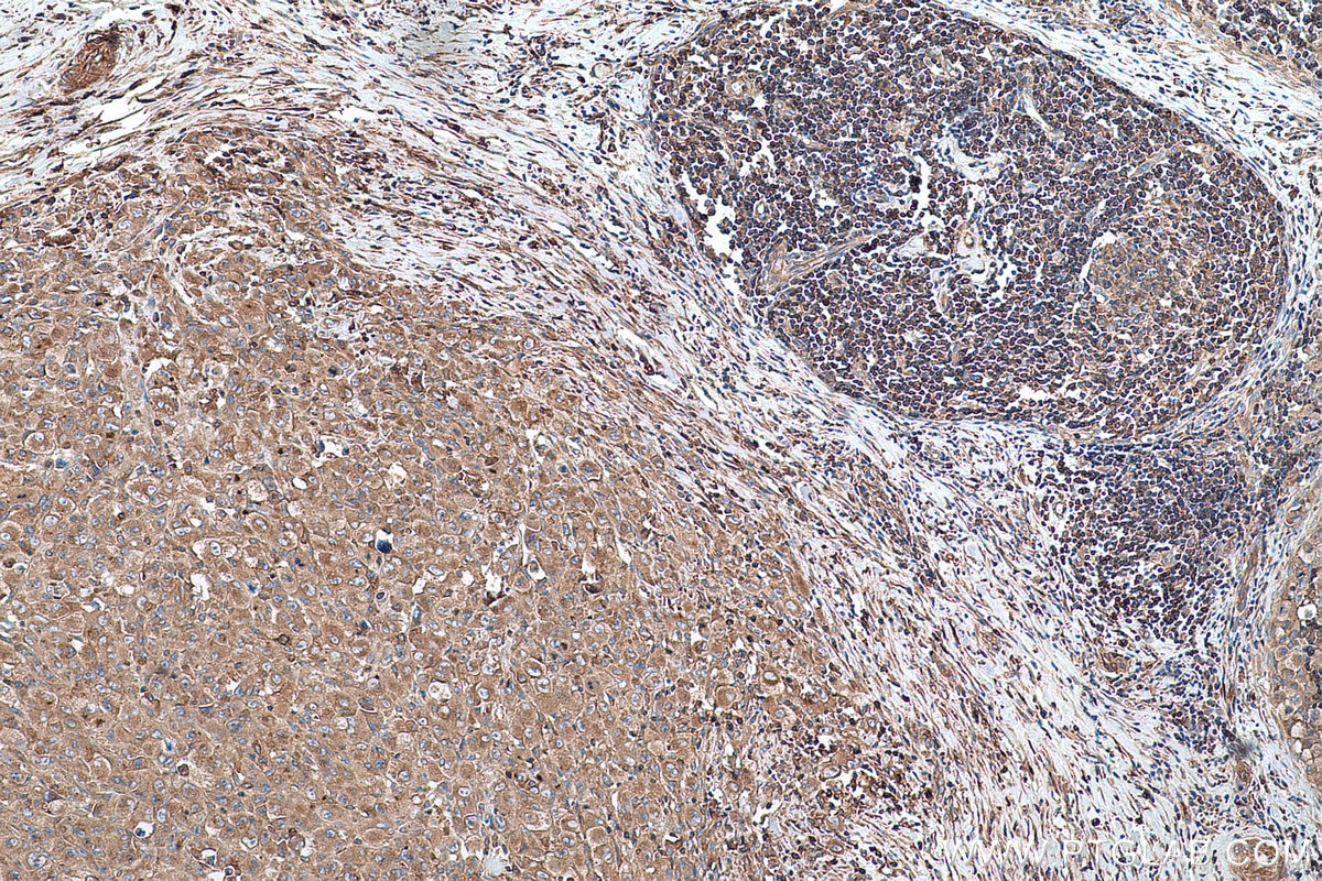 Immunohistochemical analysis of paraffin-embedded human lymphoma tissue slide using KHC0728 (ACTR2 IHC Kit).