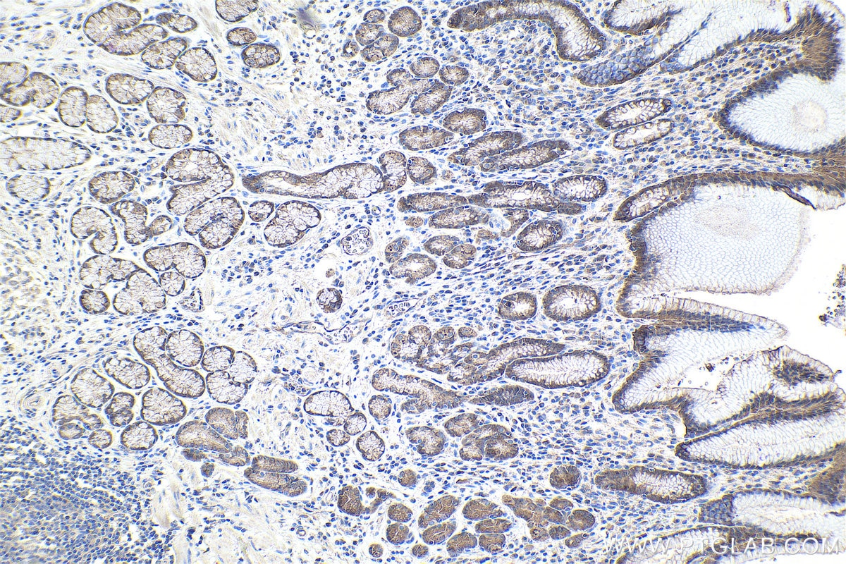 Immunohistochemical analysis of paraffin-embedded human stomach cancer tissue slide using KHC1042 (ACY1 IHC Kit).